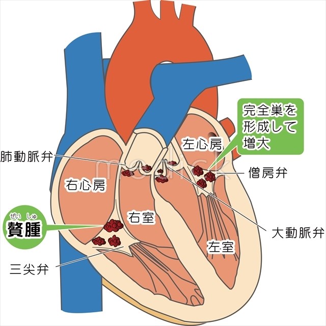 心膜炎 Pericarditis JapaneseClass.jp 心膜炎 Pericarditis JapaneseClass.jp