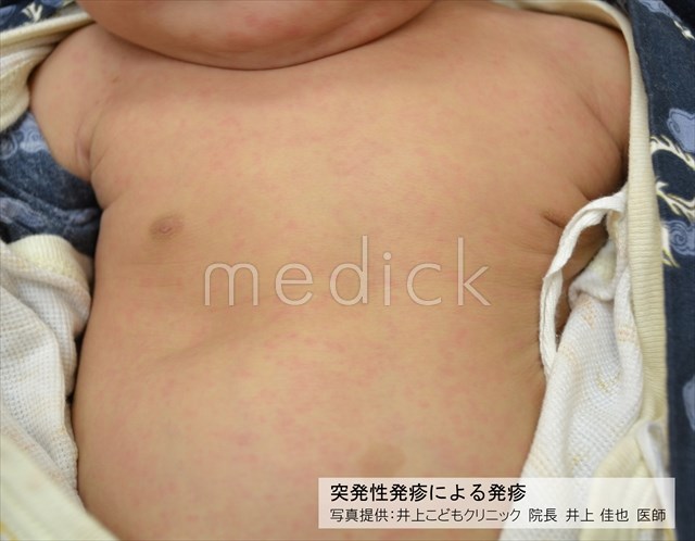 突発性発疹による発疹の写真 医療のイラスト 写真 動画 素材販売サイトのメディック Medick