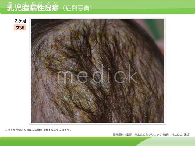 乳児脂漏性湿疹の説明スライド 医療のイラスト 写真 動画 素材販売サイトのメディック Medick