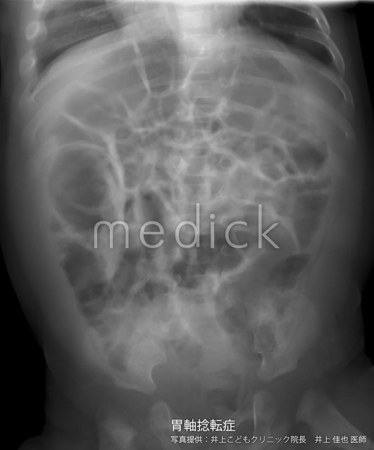 胃軸捻転症の写真 レントゲン写真 医療のイラスト 写真 動画 素材販売サイトのメディック Medick