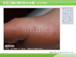 手足口病の楕円形の水疱（症例写真）の説明スライド