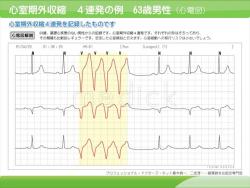 心室期外収縮　4連発の例　63歳男性（心電図）の説明スライド
