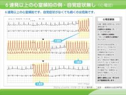 6連発以上の心室頻拍の例・自覚症状無し（心電図）の説明スライド