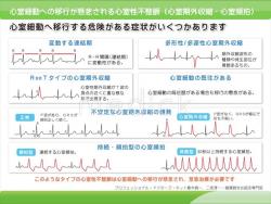 心室細動への移行が懸念される心室性不整脈の説明スライド