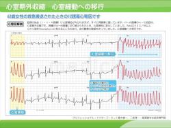 心室期外収縮　心室細動への移行例（心電図）の説明スライド