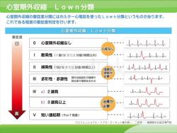 心室期外収縮のLown分類の説明スライド