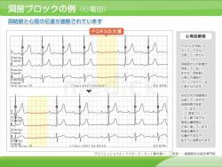 洞房ブロック症例（心電図）の説明スライド
