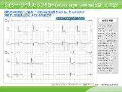 レイジー・サイナス・シンドロームとは（心電図）の説明スライド