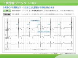 １度房室ブロックの例（心電図）の説明スライド