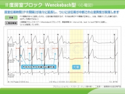 Ⅱ度房室ブロック Ｗenckebach型（心電図）の説明スライド