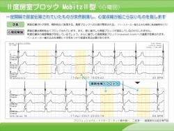 ３度房室ブロック Mobitz２型（心電図）の説明スライド