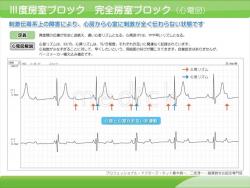 ３度房室ブロック　完全房室ブロック（心電図）の説明スライド