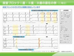 房室ブロック１度・２度・３度の混在の例（心電図）の説明スライド