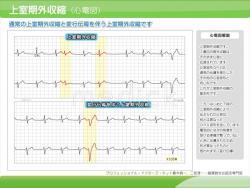 上室期外収縮の症例（心電図）の説明スライド