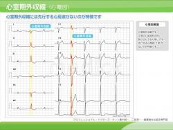 心室期外収縮症例（心電図）の説明スライド