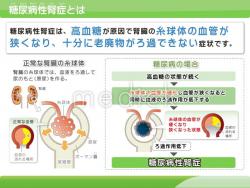 糖尿病性腎症とはの説明スライド
