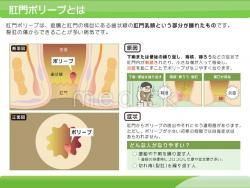 肛門ポリープとはの説明スライド