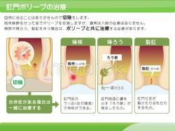 肛門ポリープの治療の説明スライド