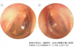 急性中耳炎9：3歳男児：左右の病態が違う症例の写真