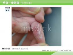 手指２度熱傷（症例写真）（10ヶ月男児）の説明スライド