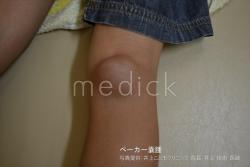 ペーカー嚢腫の写真