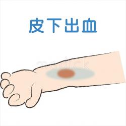 皮下出血のイラスト