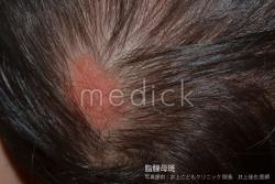 脂腺母斑の写真