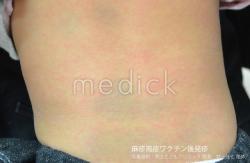 麻疹風疹ワクチン後発疹の写真