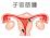 子宮筋腫のイラスト