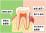 正常な歯と歯周病のイラスト