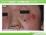 アトピー性皮膚炎：幼児顔面の病変（症例写真）の説明スライド