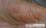 趾間の側縁の写真