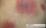 浮腫性紅斑の写真