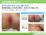 肛囲溶連菌性皮膚炎とはの説明スライド