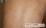 背部に生じた白癜風の写真