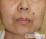 母斑（ホクロ）の写真