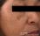 老人性色素斑の写真