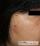 母斑、線維腫の写真