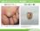 足底に生じたアテローム（表皮嚢腫）（症例写真）の説明スライド