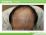 男性型脱毛症（症例写真）の説明スライド