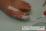 陥入爪の治療　テーピングの使用例の写真