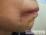 単純疱疹の写真