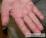 手湿疹の写真