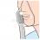 アルゴンプラズマ手術（薬剤散布）のイラスト