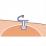 胃瘻器具のイラスト