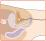 膀胱鏡検査（女性の尿道）のイラスト