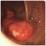 大腸がんの写真