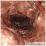 虚血性大腸炎の写真