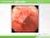 潰瘍性大腸炎の説明スライド