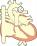 大動脈縮窄症のイラスト
